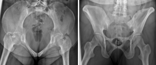 <p>Inlet - Looks like a balloon (caudal angle)</p><p>Outlet - Looks like a butterfly (cephalic angle)</p>