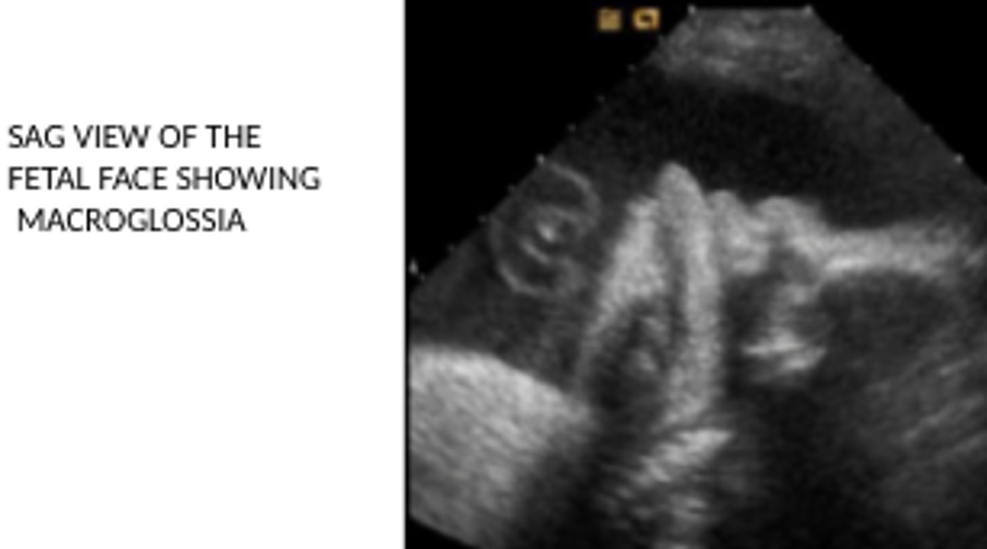 <p>1) Macrosomia (large fetus)</p><p>2) Omphalocele</p><p>3) Macroglossia</p>