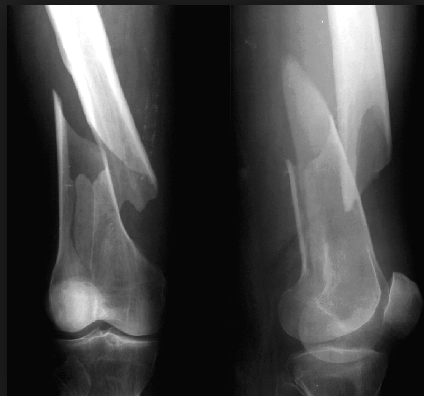 <p>Spiral fracture</p>