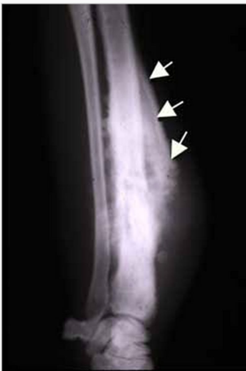 <p>the triangular area of new subperiosteal bone that is created when a lesion, often a tumour, raises the periosteum away from the bone.</p>