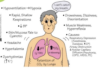 <ul><li><p>low pH, high CO2</p></li><li><p>hypoxia, decreased BP, muscle weakness, dizziness, increased potassium</p></li><li><p>causes: COPD, pneumonia, atelectasis</p></li></ul>