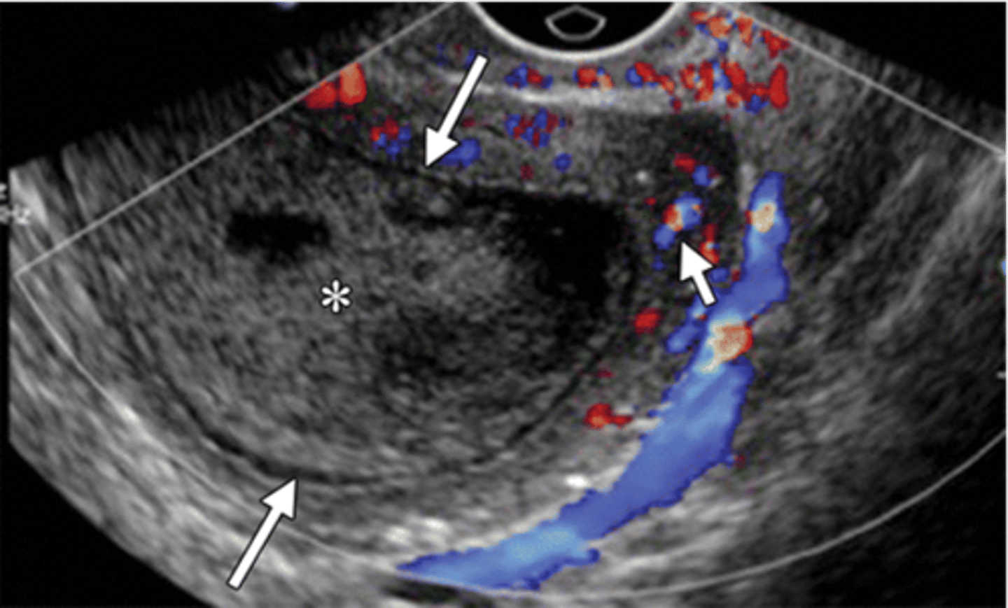 <p>dilated endometrial canal (long arrows), hyperemia of myometrium (short arrow), uterine wall thinning</p>