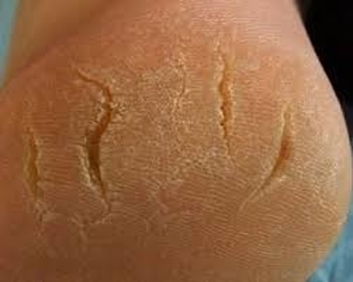 <p>Linear crack with abrupt edges; dry or moist. Examples: athlete's foot.</p>