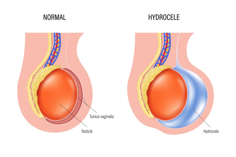 <p>Hydrocele</p>