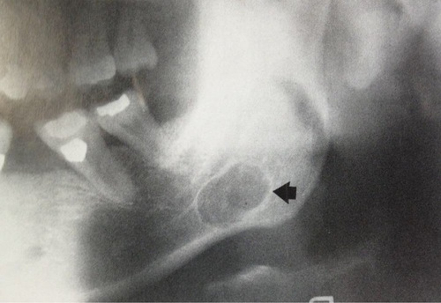 <p>salivary gland tissue.</p><p>Stafne bone cyst is a developmental invagination in the lingual aspect of the mandible that is filled with salivary gland tissue. </p><p>An empty void describes the contents of a traumatic bone cyst. </p><p>A Stafne bone cyst has no inflammatory response. It is developmental and requires no treatment. </p><p>A Stafne bone cyst is not a true cyst and does not have an epithelial lining. It contains normal salivary gland tissue.</p>