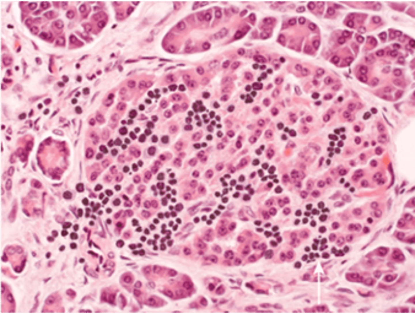 <p>Define Condition:</p><p>AUTOIMMUNE Metabolic disease involving inappropriately increasing blood glucose - Issue with INSULIN HORMONE LEVELS</p><p>-Hx:</p><p>&gt; Unknown Etiology</p><p>&gt; Genetic Susceptibility w/ Environmental Trigger (ex: Viral Infex via Coxsackievirus)</p><p>&gt; Low genetic predisposition</p><p>&gt; A/w HLA-DR3 and HLA-DR4</p><p>&gt; Onset = Child/Teens --&gt; Adults</p><p>-Path: Type IV Hypersensitivity = Failure of T cell self-tolerance -&gt; destruction of beta cells by T cells -&gt; absolute insulin deficiency</p><p>-Dx:</p><p>Labs</p><p>INSULIN LOW</p><p>&gt; Autoantibodies =</p><p>&gt;&gt; Anti-glutamic acid decarboxylase (Anti GAD-65)</p><p>&gt;&gt; Anti-islet cell Autoantibodies</p><p>&gt;&gt; Insulin Autoantibodies</p><p>Histo</p><p>&gt; Autoimmune "Insulitis" - inflammatory (LYMPHOCYTIC) infiltrate in islets</p><p>&gt; Late = Beta-cell depletion, islet atrophy, fibrosis</p>