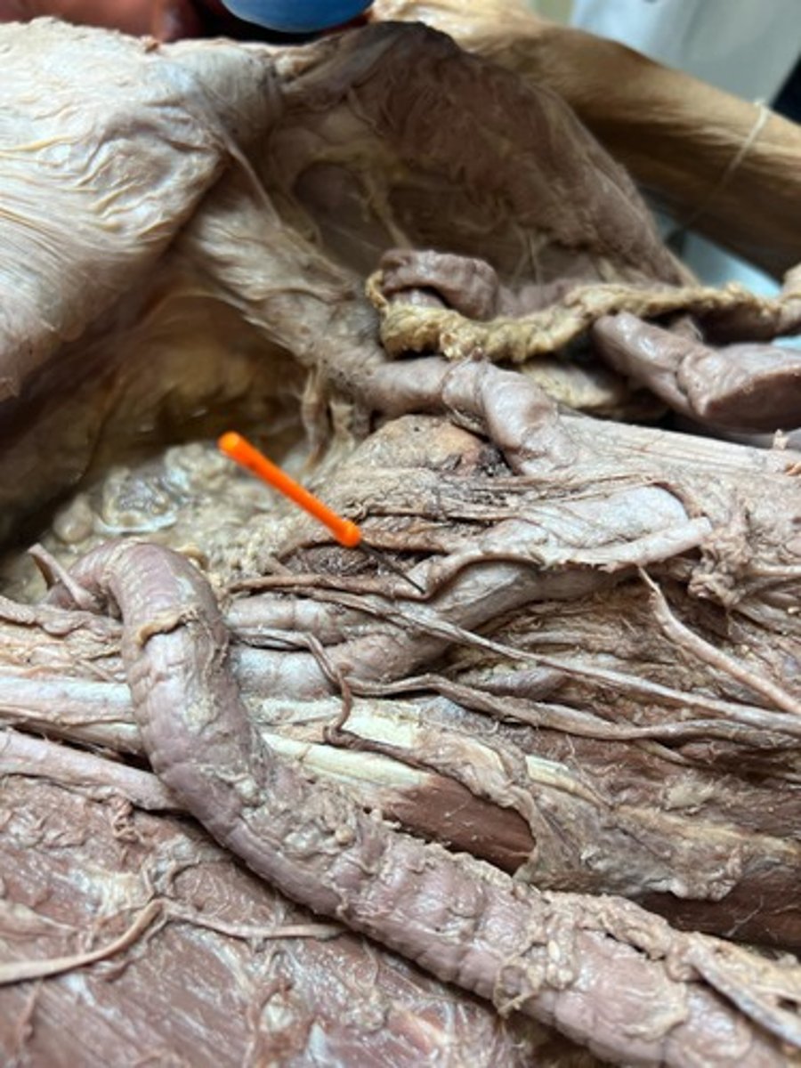 <p>sigmoid artery</p>