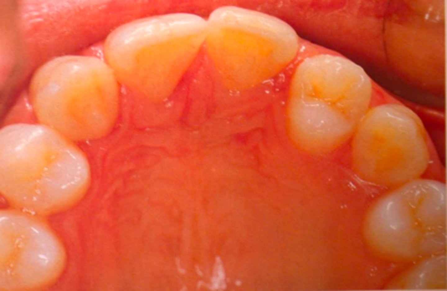 <p>ID the developmental disturbance:</p>