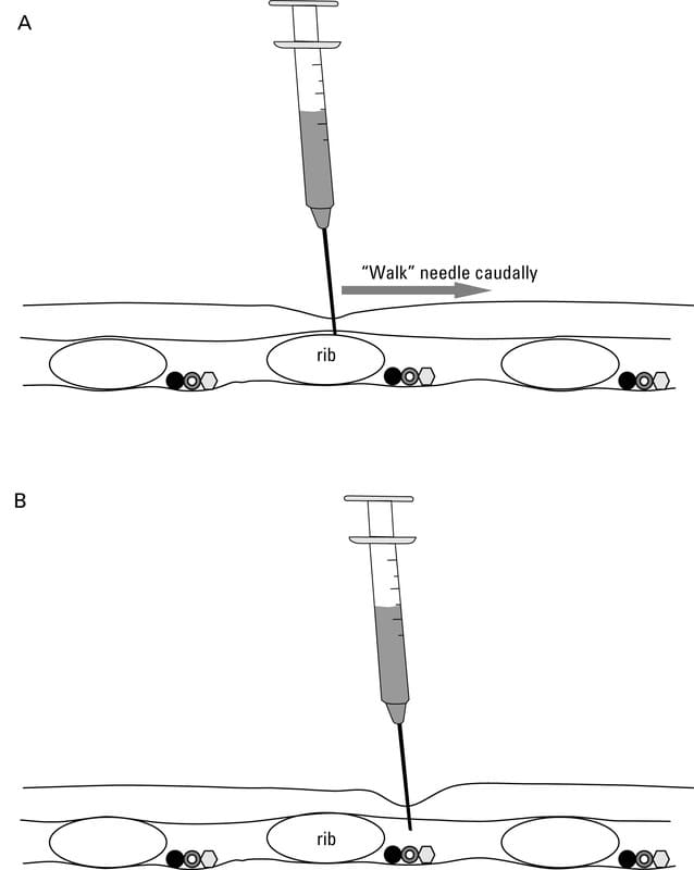 <p>Insert needle on dorsal surface of rib, keeping as caudal as possible, till you hit bone surface. Then direct caudally along surface of rib until it reaches soft tissue. 2-3 intercostal nerves are blocked before &amp; after planned target area</p>