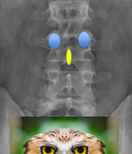 <ul><li><p>on AP projections all vertebrae should have an owl face</p></li><li><p>Eyes - pedicles, you should always see two of them</p></li><li><p>Beak - spinous process</p></li><li><p>Easiest to see in the lumbar spine but can be used throughout </p></li></ul><p></p>