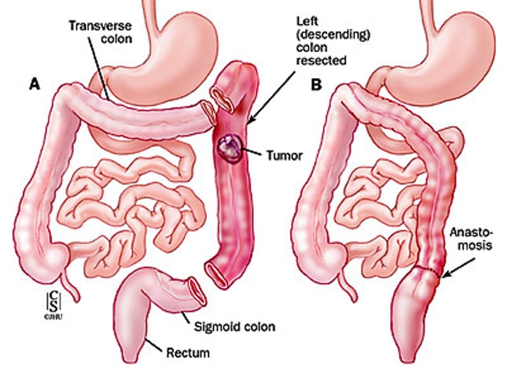 <p>removal of part of the colon<br>- shortens GI tract</p>