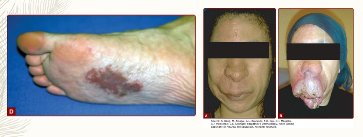 <p><strong>Arteriovenous Malformation Clinical Manifestations</strong></p><p>Physical Exam</p><p>-___________ / macular stains</p><p>-Faint, red-purple, ill-defined cutaneous ____</p><p>-Slightly compressible</p><p>-+ palpable pulsations or _____</p><p>-+ audible ____</p><p>-Stages I - IV, based on progression</p>
