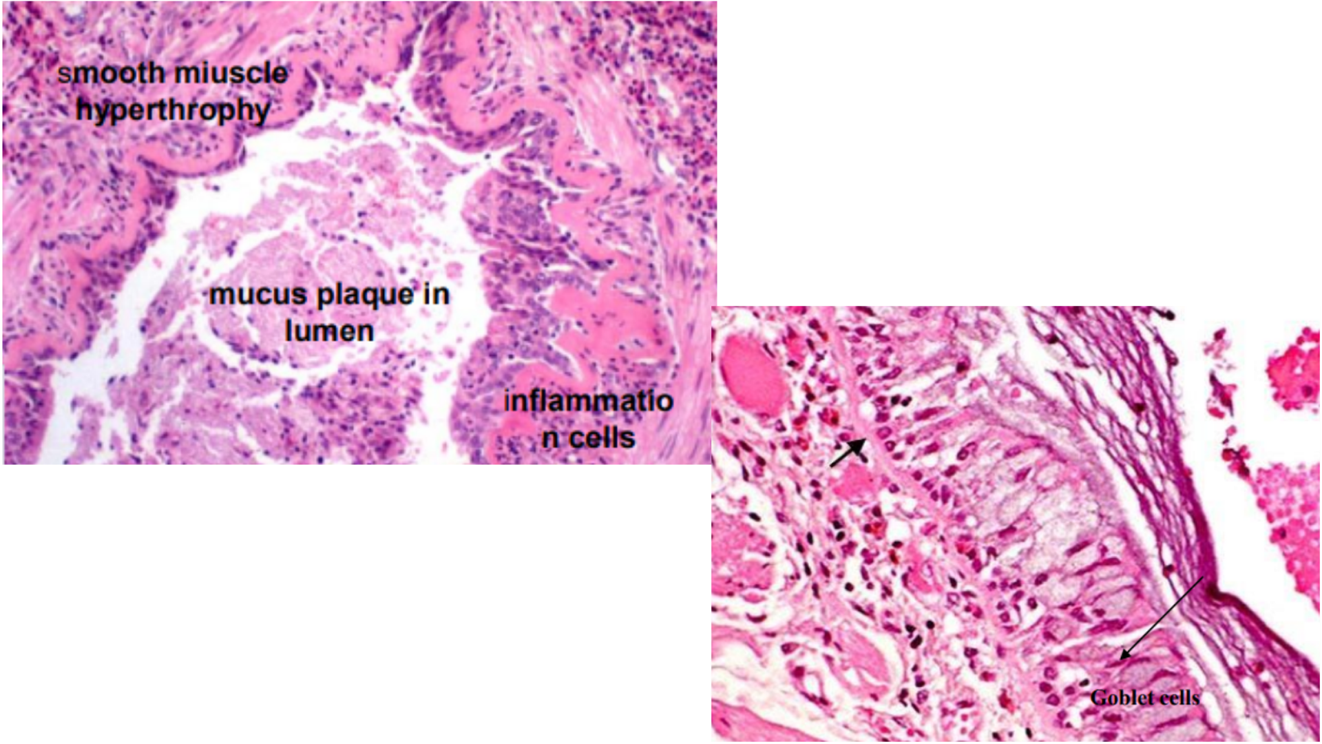 <p>Asthma</p>