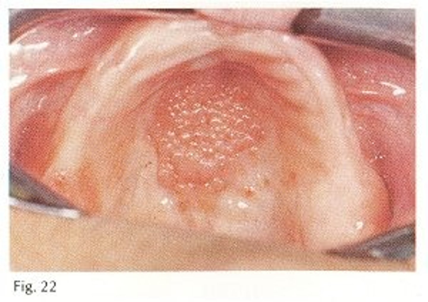 <p>-Related to denture irritation</p><p>-Appears as a hyperplasia of the palatal tissue, usually red and swollen</p>