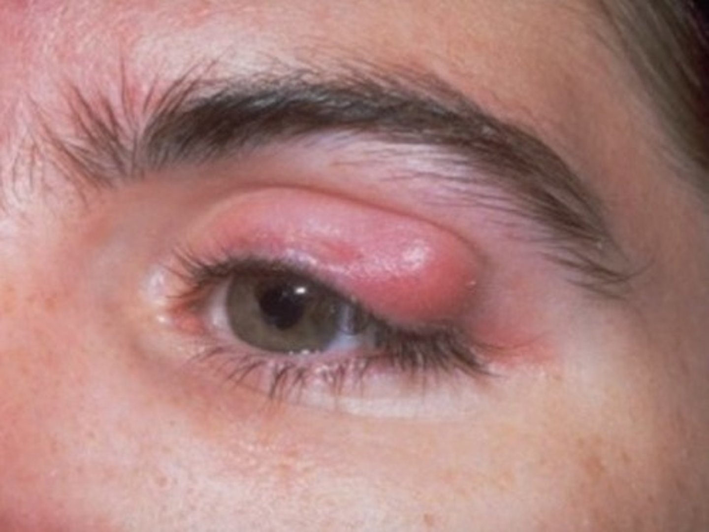 <p>chronic blockage of meibomian gland; usually painless</p>