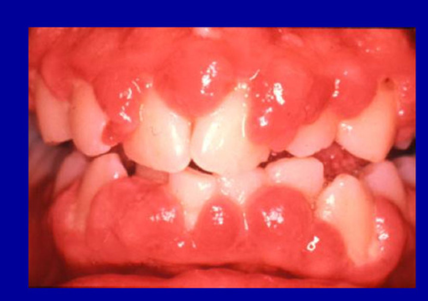 <p>Immunosuppressant</p><p>• more vascularized than phenytoin induced enlargements</p><p>• 20-70% occurrence</p><p>• plasma cell infiltrate suggests hypersensitivity response</p>