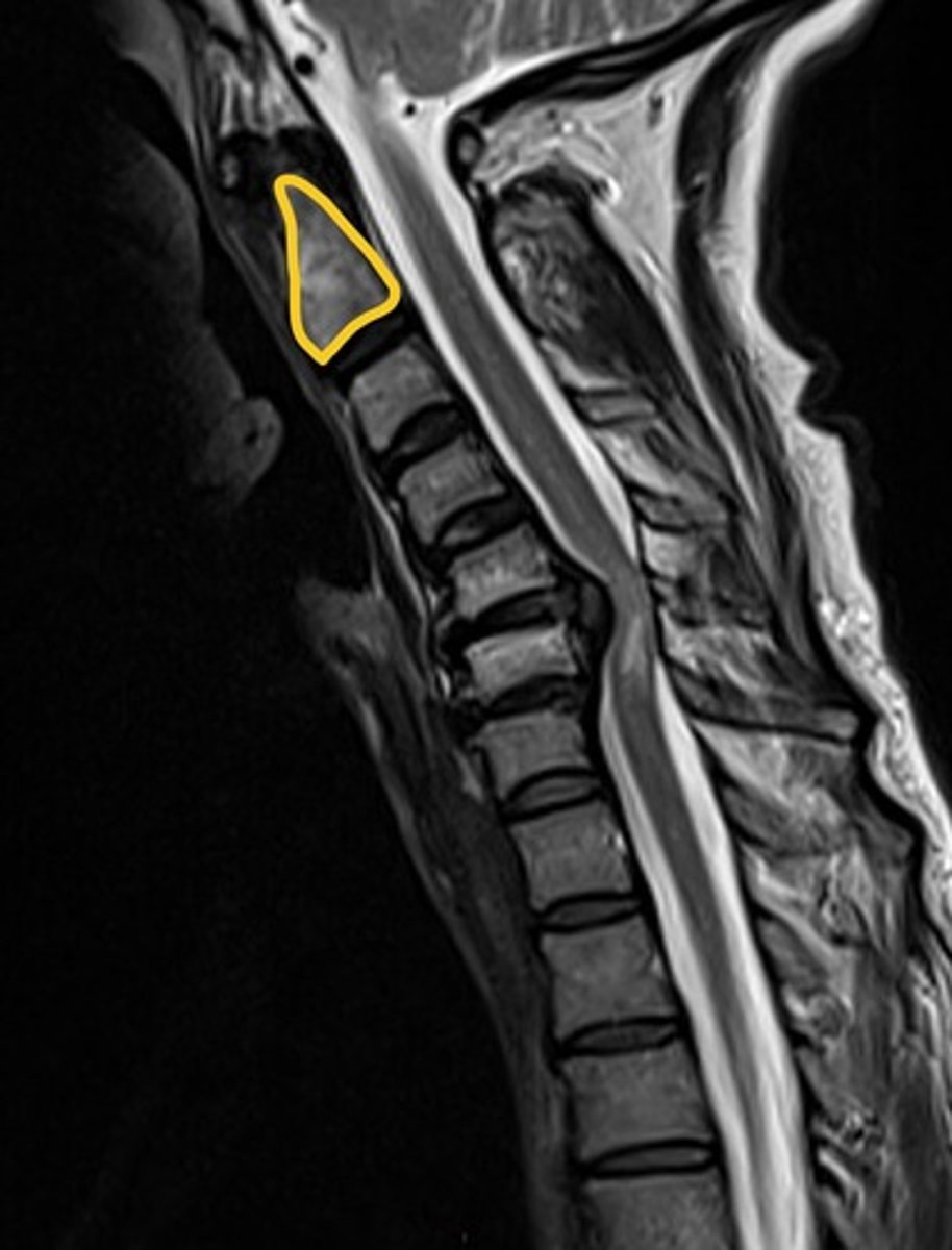 <p>Explain the anatomical deficit that is occurring. What is the circled vertebra? what might be a cutaneous deficit the patient is experiencing?</p>