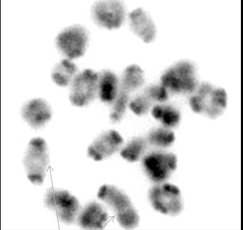 <p>→ meiose I profase: diakinese</p><ol><li><p><span style="color: rgb(30, 223, 37);">groen: Y chromosoom</span></p></li><li><p><span style="color: rgb(234, 34, 34);">rood: X chromosoom</span></p></li><li><p><span style="color: rgb(60, 91, 234);">blauw: DNA</span></p></li></ol><p></p><p>→ chromosomen gaan sterk condenseren, nucleaire membranen verdwijnen</p><p>→ thv chromosoom armen: genetische cross-over is gebeurd</p><p>→ ‘lijm’ moet nog worden verwijderd voor chromosomen nr spindle pool kunnen</p><p>→ X en Y hangen aan elkaar vast door ‘lijm’ thv pseudo autosomale regio</p><p></p>