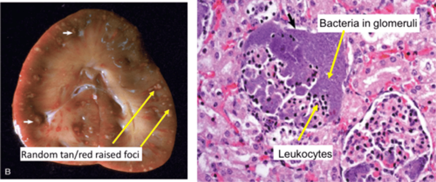 <p>Bacteria lodge in glomerular &amp; interstitial capillaries</p><p>Formation of multiple cortical microabscesses</p><p>Random tan/red, raised foci of gross pathology</p><p>Leukocytes &amp; bacteria in glomeruli on microscopic pathology</p>