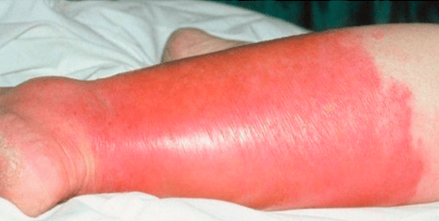 <p>Bacterial Skin Infections:</p><p>If a pt presented w the following S/S, what may we suspect they have:</p><p>-effecting epidermis layer</p><p>- prodrome of malaise, anorexia, fever</p><p>- erythema, warmth, <strong>shiny, and edematous plaques</strong>; very<strong> well-defined</strong></p><p>- pain at site</p>