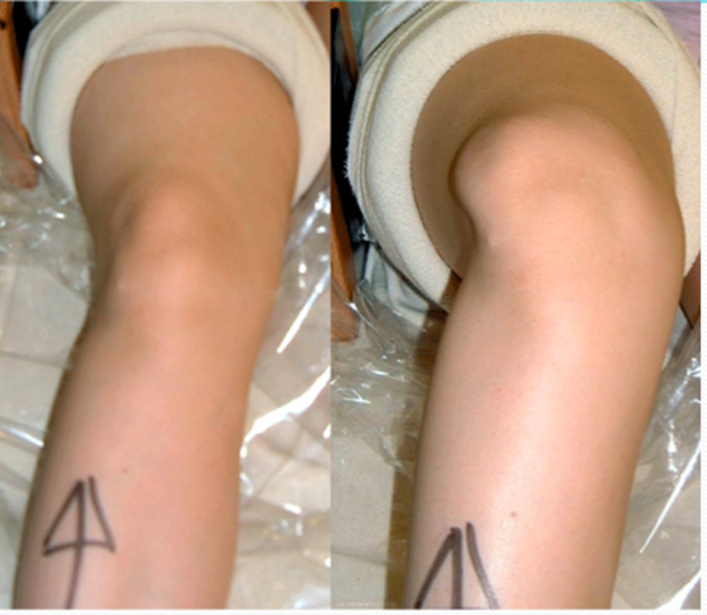 <p>- diagnosis: patellar instability</p><p>- how: patient sitting on side of bed, extend knee</p><p>+ = arc movement of patella</p>