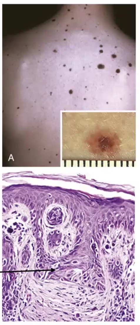 <ul><li><p>Lesions with variable pigmentation and irregular borders, usually larger than normal nevi</p><ul><li><p>Increases risk for melanoma</p></li></ul></li><li><p>Micro-Morphology:<strong> irregular nests that bridge</strong></p></li></ul><p></p>