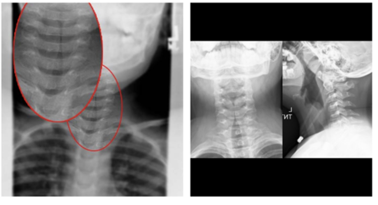<p>ID abnormality - what dz is this indicative of?</p>