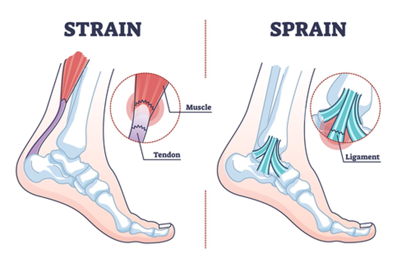 <p>the muscles and tendons can tear (strain)</p>