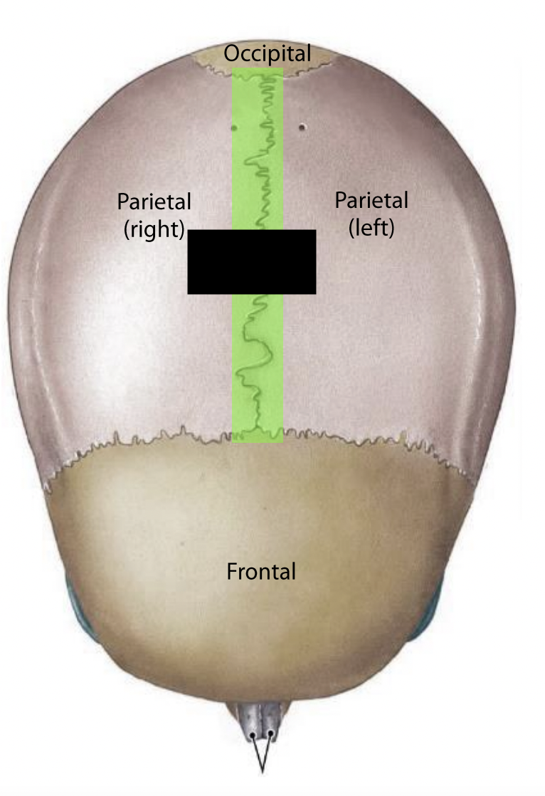 What suture is this?