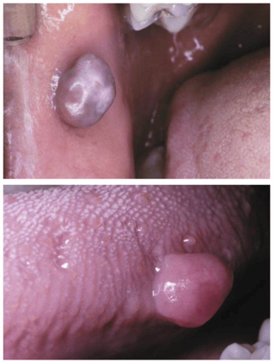 <p>• Well-localized</p><p>• Dome-shaped</p><p>• Asymptomatic (unless secondary</p><p>ulceration)</p><p>• Smooth surface</p><p>• Often pink but may be ulcerated</p><p>if traumatized</p><p>• Sessile or pedunculated</p>