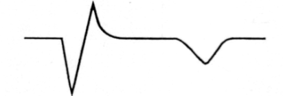 T wave inversion in the affected leads, which can be detectable for several months after the infarction.
