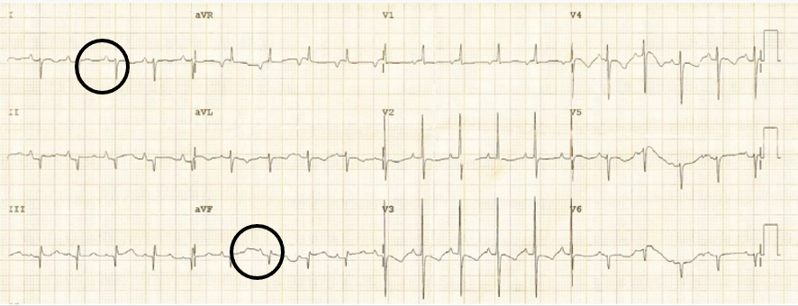 <p>both leads I and aVF are negatively deflected</p>