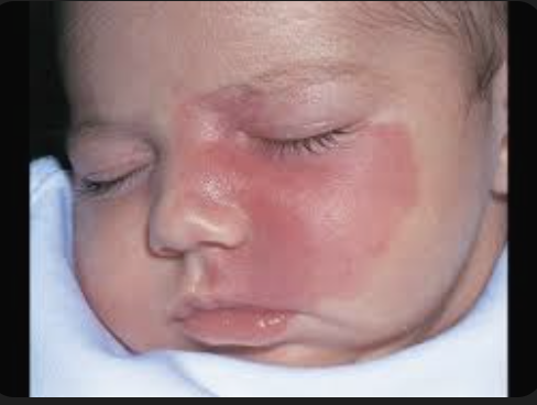 <p>AKA Port Wine Stain. Reddish or flat pink lesion that does not blanch with pressure caused by dilated capillaries below the epidermal skin</p>