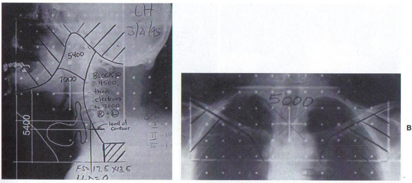 <p>should cover from the skull base to the cricoid cartilage with an anterior split neck field to treat LN below cricoid</p>