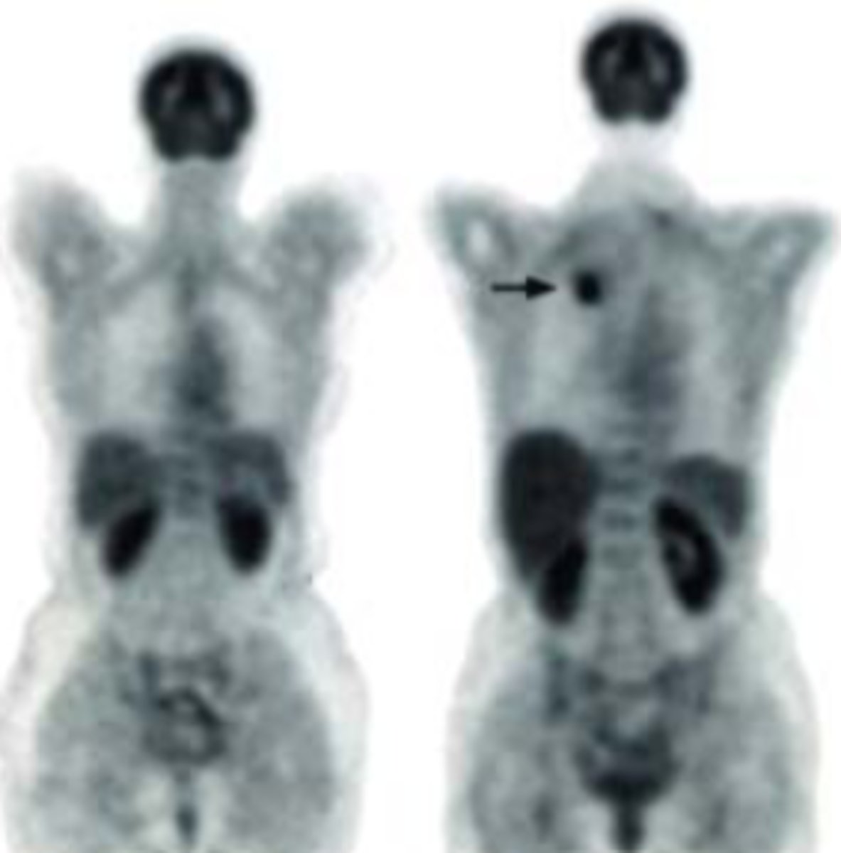 <p>Positron Emission Tomography</p>