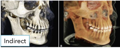 <ul><li><p><span style="color: #000000">Computationally complex</span></p></li><li><p><span style="color: #000000">Uses segmentation process to produce volumetric surface reconstruction with depth</span></p></li></ul><p></p>