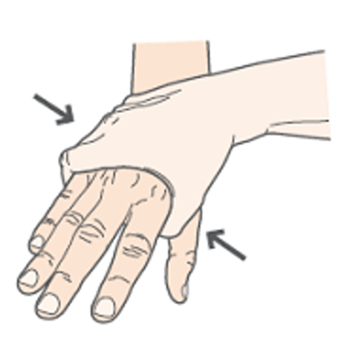 <p>Positive (painful) metacarpophalangeal joint squeeze (MCPJ) test </p>