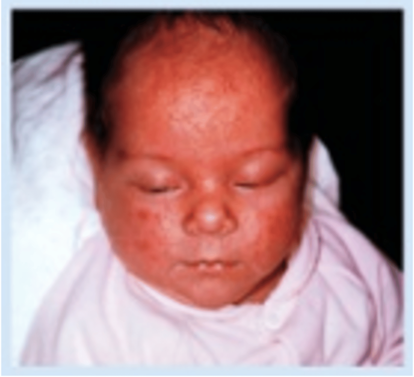 <p>scattered vesicles on an erythematous base</p><p>results from obstructed sweat glands</p><p>disappears spontaneously within weeks</p>