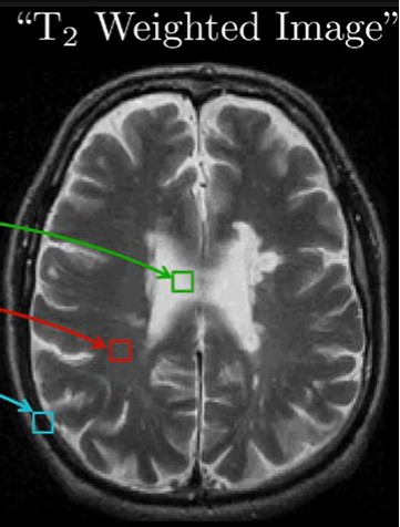 <p>based on imaging using echo times, the voxel tells us how quickly the precessing spins in the voxel got out of phase with each other</p><p>bright if they dephase slowly</p><p>dark if they dephase quickly</p>