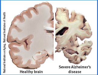 <p>a progressive neurodegeneration and fatal condition (difficulty remembering new information, inability to do everyday task; speech, recognition, and memory decline)</p>