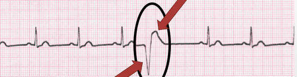 <p>early in the cardiac cycle; R on T; wide QRS; can be grouped</p>