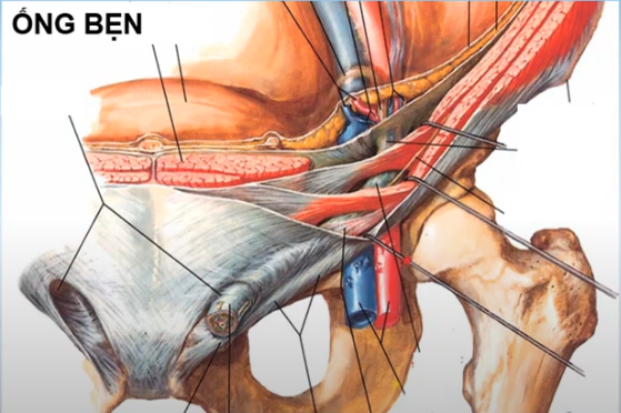 <p>D. Túi thoát vị nằm <u>trong</u> bó mạch thượng vị dưới</p><ul data-type="taskList"><li data-checked="true" data-type="taskItem"><label><input type="checkbox" checked="checked"><span></span></label><div><p>B. Thoát vị đùi: túi thoát vị nằm dưới dây chằng bẹn</p></div></li><li data-checked="true" data-type="taskItem"><label><input type="checkbox" checked="checked"><span></span></label><div><p>C. Thoát vị bẹn gián tiếp: túi thoát vị chui qua lỗ bẹn sâu</p></div></li><li data-checked="true" data-type="taskItem"><label><input type="checkbox" checked="checked"><span></span></label><div><p>Lỗ bẹn sâu nằm ngoài so với bó mạch thượng vị dưới <span data-name="arrow_right" data-type="emoji">➡</span> Ngoài bó mạch thượng vị dưới <span data-name="arrow_right" data-type="emoji">➡</span> Đi qua lỗ bẹn sâu <span data-name="arrow_right" data-type="emoji">➡</span> trong ống bẹn <span data-name="arrow_right" data-type="emoji">➡</span> Thoát vị bẹn gián tiếp <span data-name="arrow_right" data-type="emoji">➡</span> Không đi trực tiếp qua thành bụng.</p></div></li></ul><p></p>