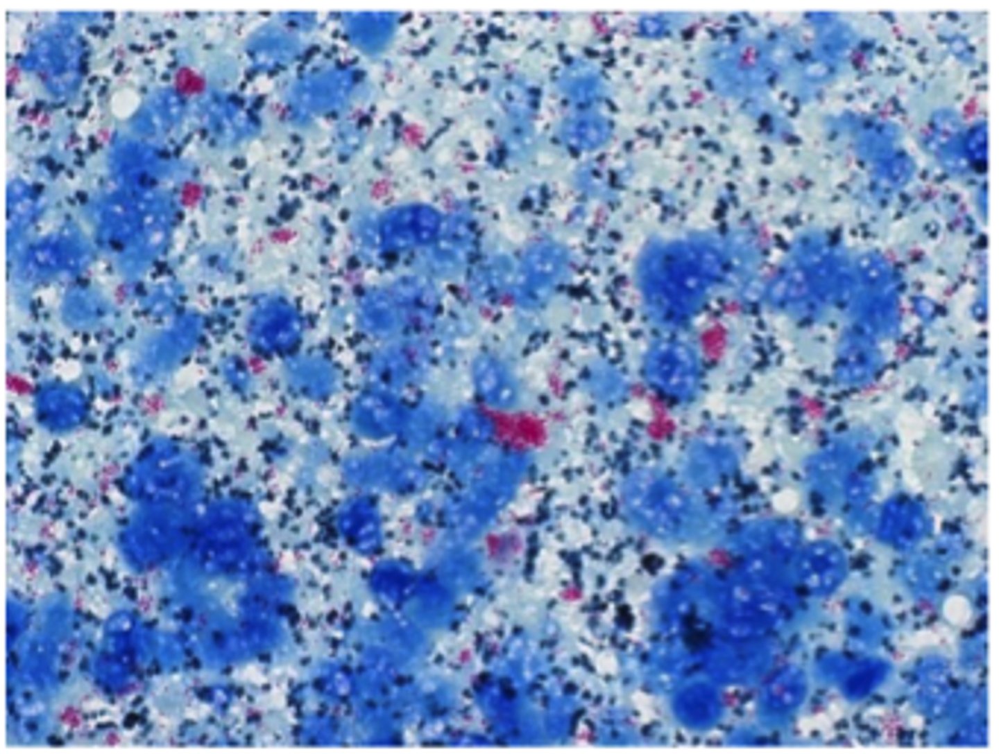 <p>A Ziehl-Neelsen (ZN) stained histological preparation of ileum mucosa from a cow suspected of Johne's</p><p>disease. Note the clumped acid-fast (bright red/pink) bacilli. Why are they clumped?</p>