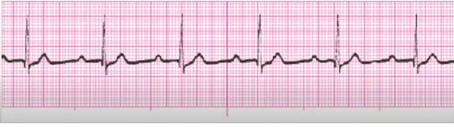 <p>delay within underlying rhythm, slowing down (not an actual block)</p><p>regular rhythm, just &gt; 0.20 PR interval</p><p>occurs within underlying rhythm&nbsp;</p><p>hold meds if over 0.26 seconds</p><p>check with pcp with digoxin or antiarrhythmics</p><p>post MI: monitor for more serious block</p>