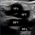 <p>What is site 4 of a DVT?</p>