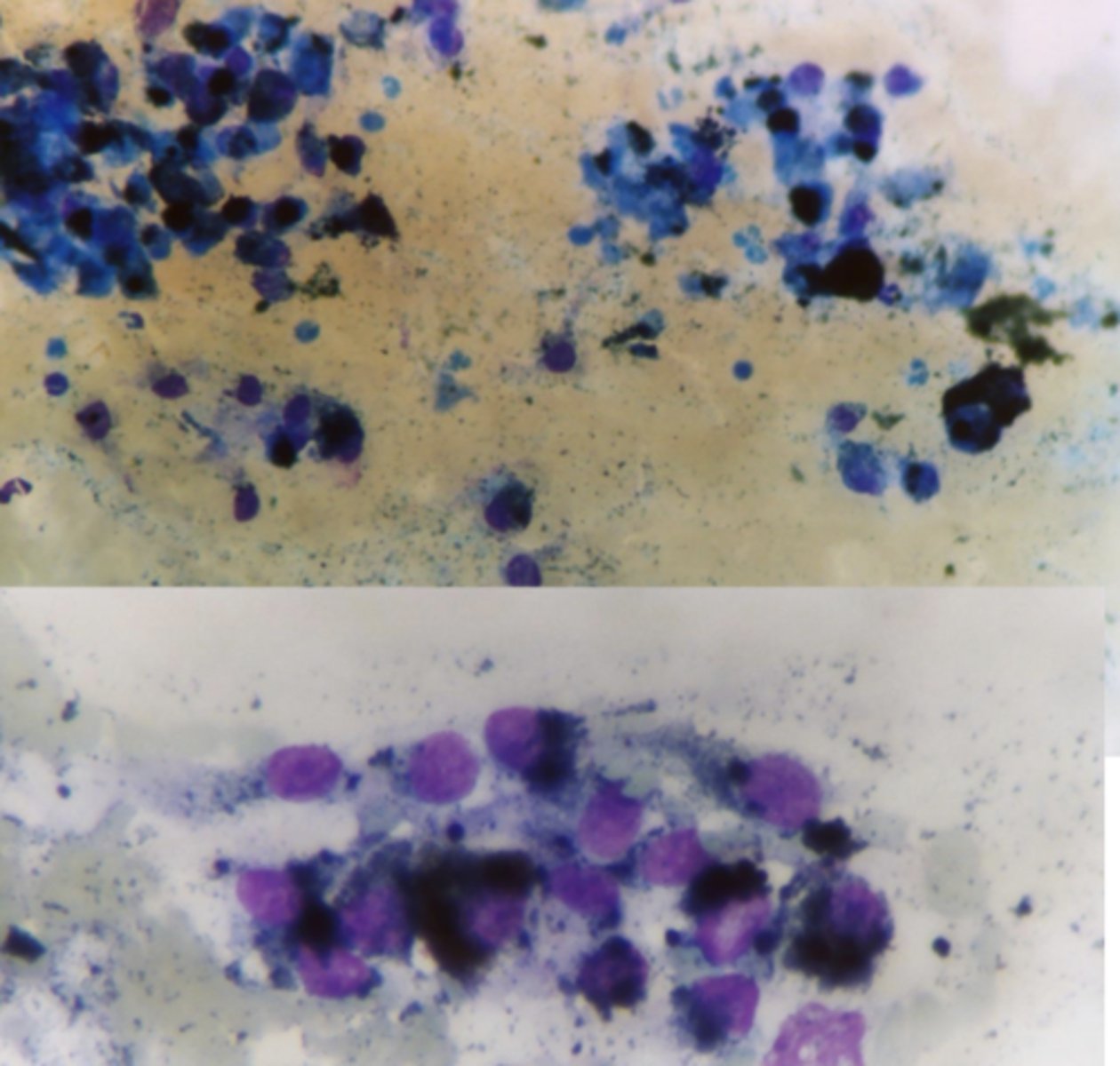 <p>What type of tumor is this cytology sample taken from?</p>