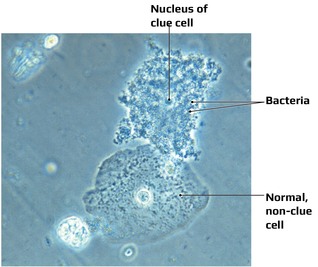 <p><span><span>Agent: </span><em><span>Gardnerella vaginalis</span></em><span>, </span></span></p><p><span><span>Signs and symptoms: </span></span><span style="background-color: transparent;"><span>White vaginal discharge with a </span><strong><span>“fishy” odor</span></strong><span>; Itching and irritation of the vaginal opening; </span></span></p><p><span style="background-color: transparent;"><strong><span>Clue cells </span></strong><span>differentiate from vaginal candidiasis</span></span></p>