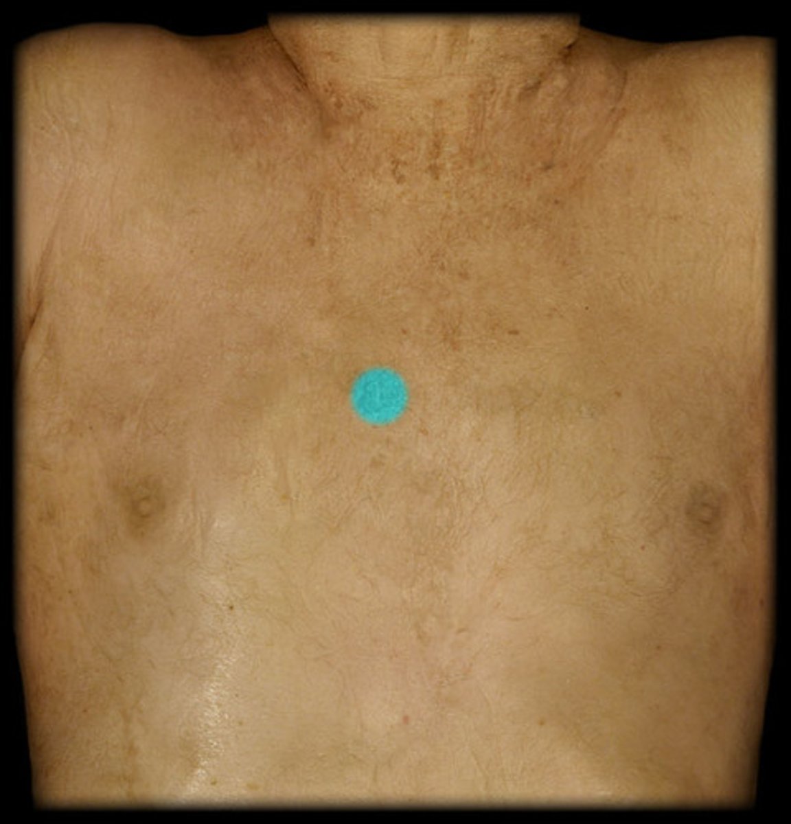 <p>2nd intercostal space, R sternal border</p>