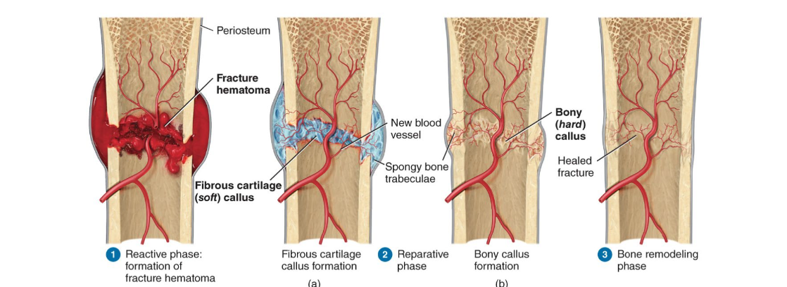 <p>Reactive phase is early inflammatory phase</p><p>Reparative phase includes formation of fibrocartilaginous callus first and a bony callus second</p><p>Bone remodeling phase is last step as the bony callus is remodeled</p>