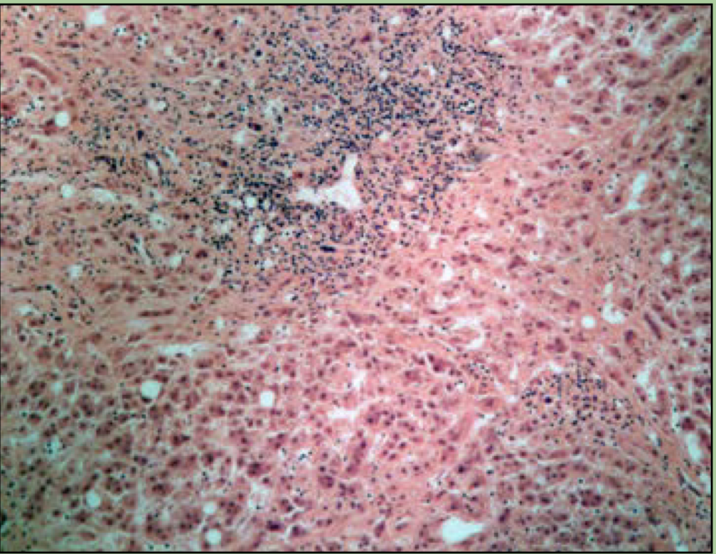 What disorder is this?